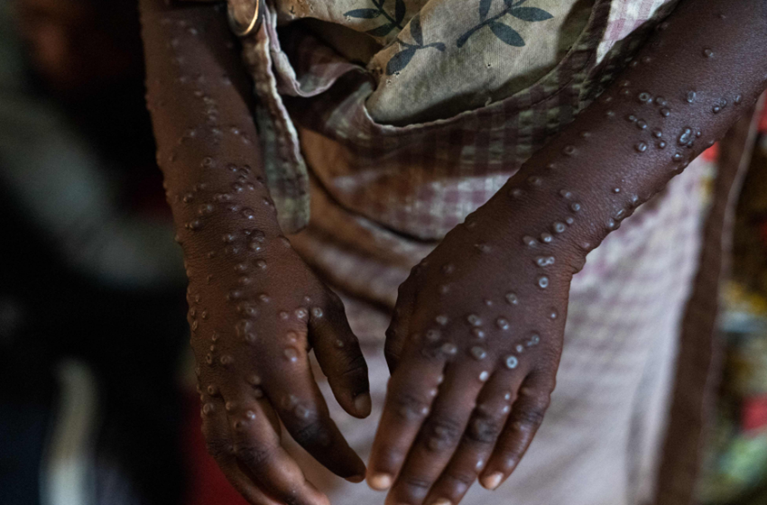  La variole du singe toujours présent au Burundi